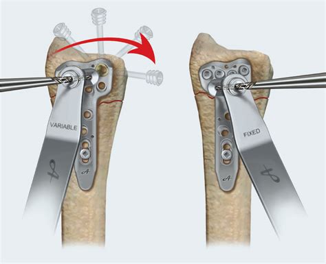 Avanti Distal Radius Fracture Fixation By Avanti