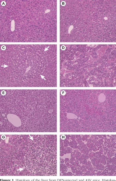 Figure From Tumorigenesis And Neoplastic Progression Overexpression