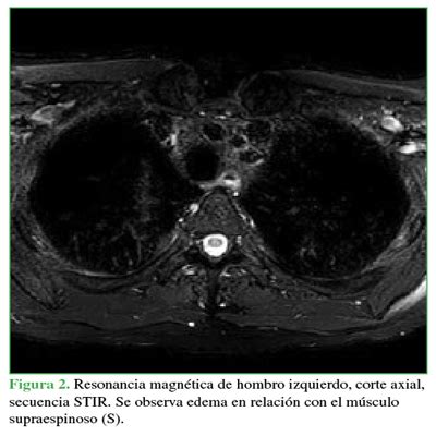 Descompresión artroscópica para la neuropatía del nervio supraescapular