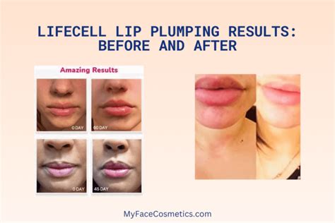 Lifecell Lip Plumping Treatment Review Updated