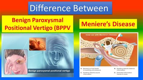 Difference Between Benign Paroxysmal Positional Vertigo Bppv And Meniere’s Disease Youtube