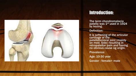 Chondromalacia Patella Desktop G8n93pspptx