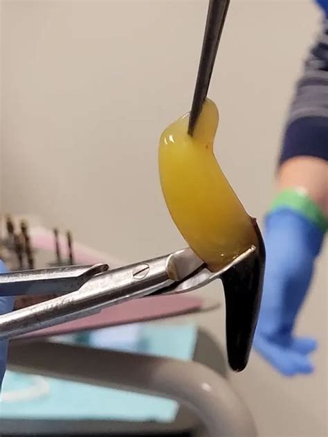 Advanced Platelet Rich Fibrin Palm Beach Dental Implants