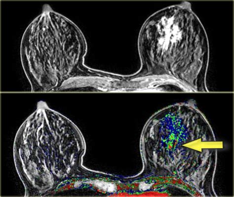 The Radiology Assistant Mri Of The Breast