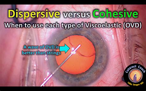Review Dispersive Vs Cohesive Viscoelastics Cataract Coach