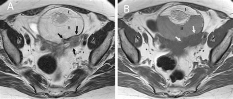 Malignant Transformation In A Mature Cystic Teratoma Axial T Weighted