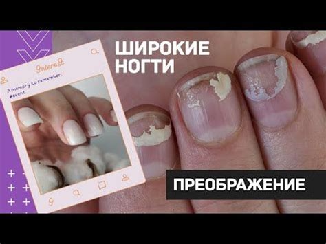 ШИРОКИЕ ногти: преображение. Наращивание ногтей гелем. Как подобрать ...