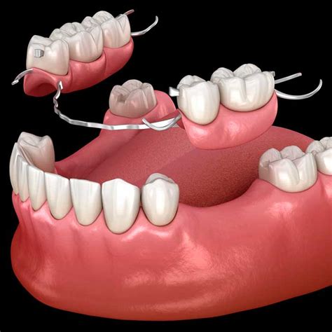 Cu Nto Tiempo Hay Que Esperar Para Poner Una Pr Tesis Dental