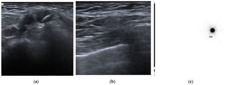 Cancers Free Full Text Selective Axillary Dissection After