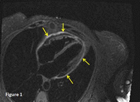 [Solved] what causes pleural friction rub on a patient diagnosed with ...