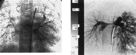 A Bilateral Diffuse Pulmonary Arteriovenous Malformations In A