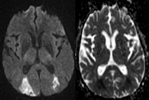 Border Zone Infarcts Pathophysiologic And Imaging Characteristics