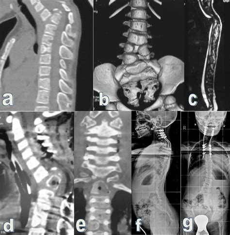 Case 2 (Tables 2, 3): girl with VATER syndrome. a, b CT of the spine at... | Download Scientific ...