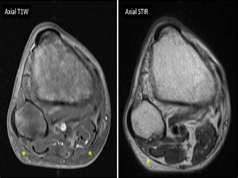 Figure 1 From Serous Atrophy Of Bone Marrow A Rare Disorder Worth