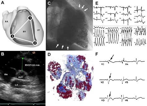 Arrhythmogenic Right Ventricular Cardiomyopathy Cardiac Electrophysiology Clinics