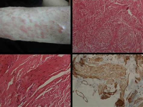 A case of leiomyoma where final diagnosis was confirmed by ...