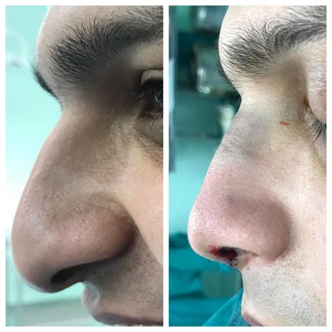 Rhinoplasty Cost Pakistan Lahore Cosmetic Nose Job Surgery