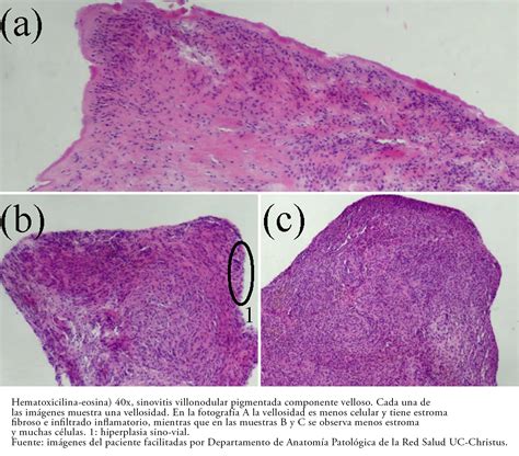 Tratamiento artroscópico de sinovitis villonodular pigmentada de