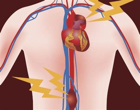 L anévrisme de l aorte Symptômes et traitement Doctissimo