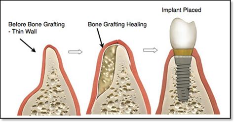 Bone Grafting Austin Tx Sinus Lifts Hill Country Oral Surgery