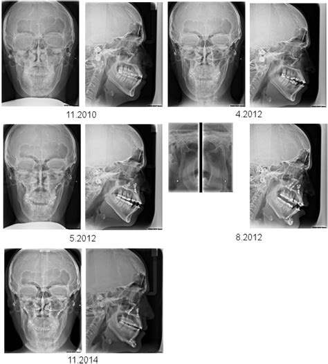 A Series Of Cephalometric Radiographs Depicting The Patient In