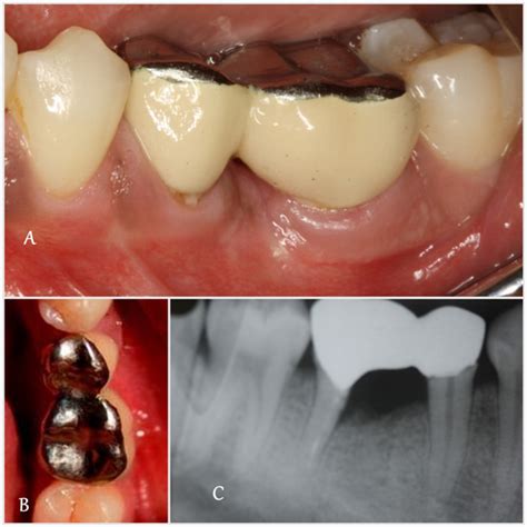 root resection  future implant site development  transitional