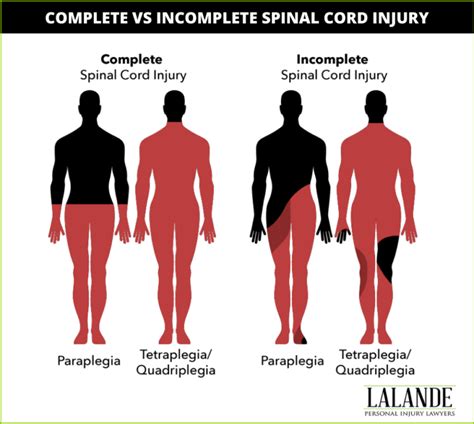 Complete Spinal Cord Injuries Lalande Personal Injury Lawyers