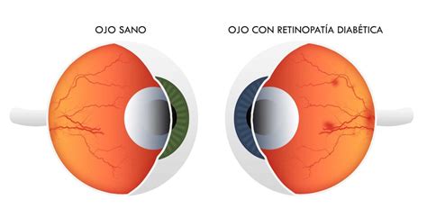 Panamericano de Ojos La retinopatía diabética puede causar perdida