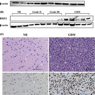 Rbpj Knockdown In Glioblastoma Stemlike Cells Gscs Suppressed Tumor