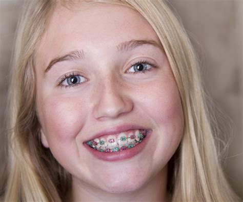 Traditional Metal Braces | West Arvada Orthodontics