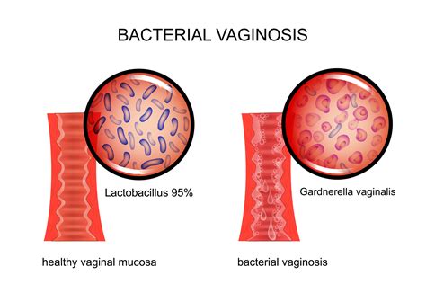 Vaginal Infections Womens Health Issues