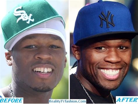 Hitman Holla Teeth Fixed Before And After