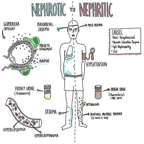 Nephrotic Vs Nephrotic Syndrome Paediatrics Renal Kidney Medic