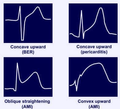 ECG changes in Pericarditis | Epomedicine