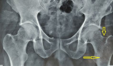 Radiograph Of The Pelvis Anteroposterior View Showing The Diffuse