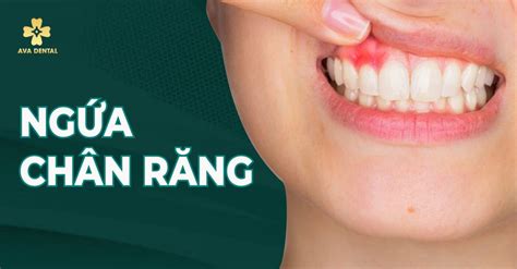 Ngứa chân răng Nguyên nhân và cách điều trị hiệu quả