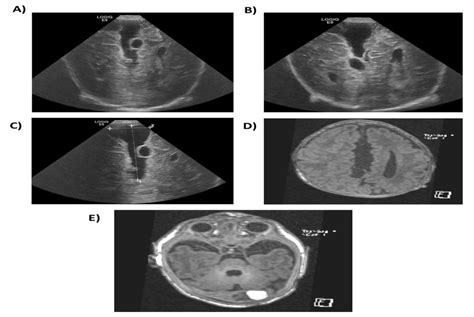 The Ultrasound And Mri Scan Images Of The Case With Oral Facial Digital