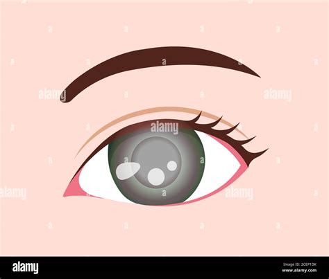 Eye Disease Vector Illustration Glaucoma Stock Vector Image And Art Alamy