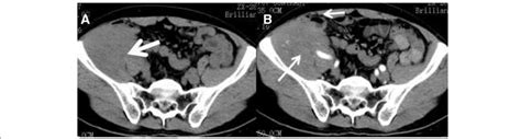 A Right Intra Abdominal Undescended Testis Secondary Seminoma A A Ct