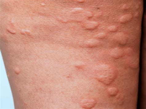 Hives Rash Pictures