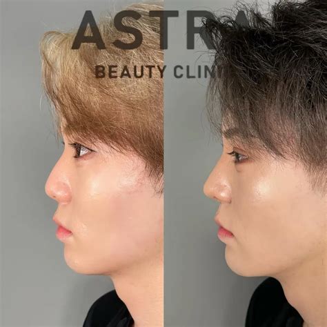 理想の鼻は男女で違う男性におすすめ鼻整形を紹介 【公式】astra Beauty Clinic（アストラビューティクリニック）｜美容外科