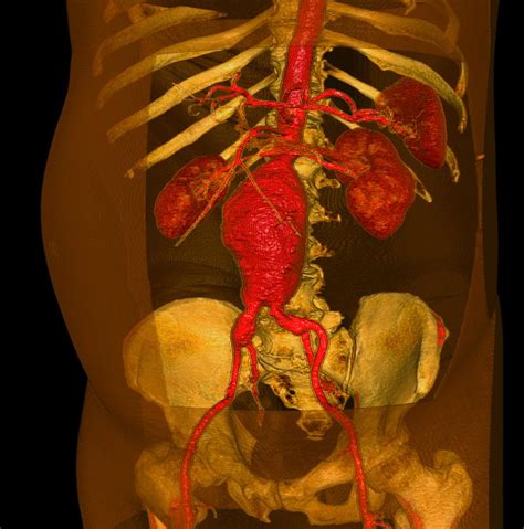 Aortic Aneurysm 3 D Ct Scan Photograph By Du Cane Medical Imaging Ltd