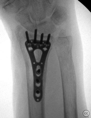 Volar Barton S Volar Rim Fracture Distal Radius