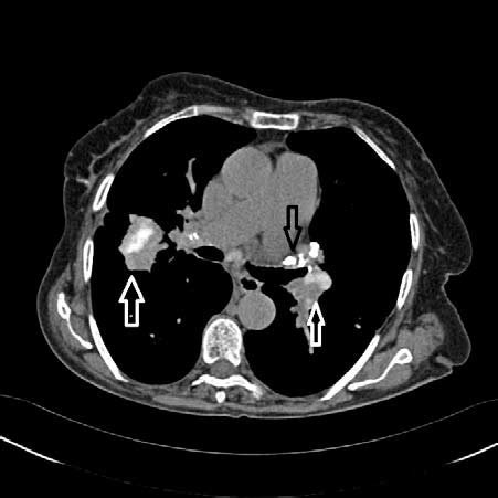 Calcified mass (white arrow) and lymph nodes (Black arrow) in an ...