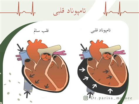 تامپوناد قلبی علت تامپوناد قلبی روش تشخیص تامپوناد قلبیدرمان