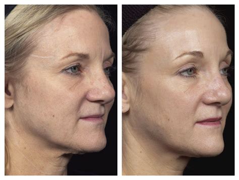 Thermage Flx Skin Tightening Woods Aesthetics