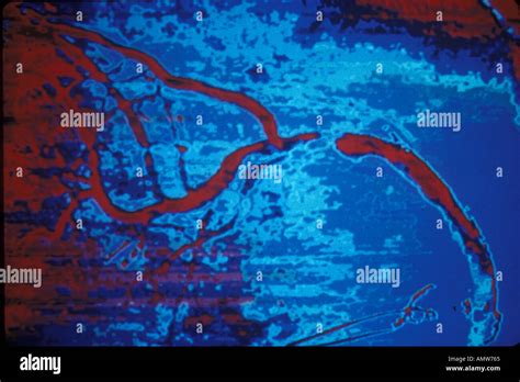 Occluded Coronary Artery Stock Photo - Alamy