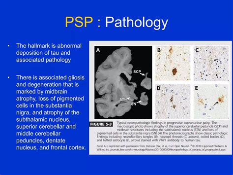 Parkinson Plus Syndrome Ppt