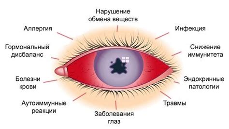 Увеиты: симптомы и лечение - Medside.ru