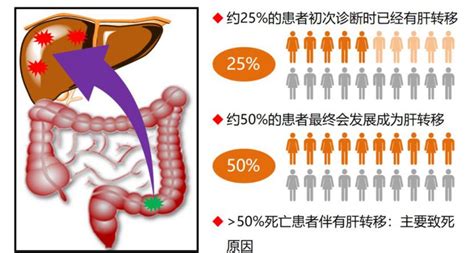 确诊结肠癌肝转移，她通过这个方法消除肿瘤 知乎